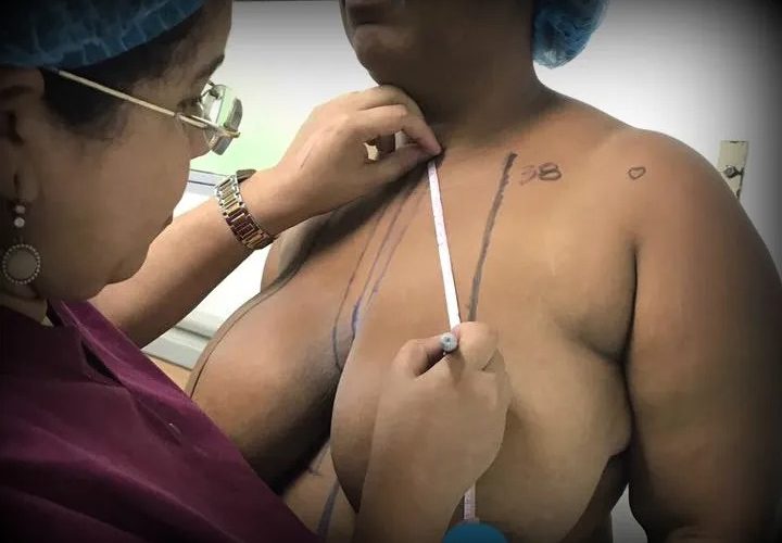 Cirujano Vargas Almonte aboga por que las ARS cubran las cirugías de reducción mamaria